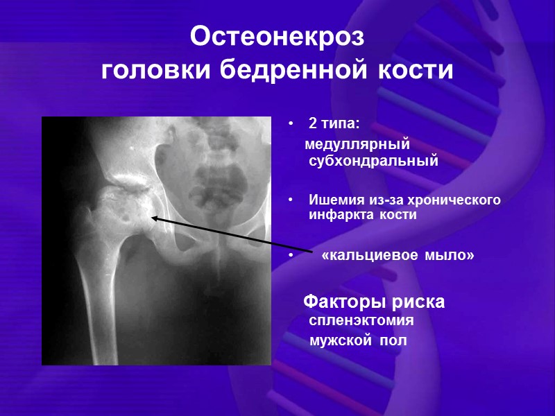 Остеонекроз  головки бедренной кости  2 типа:      медуллярный